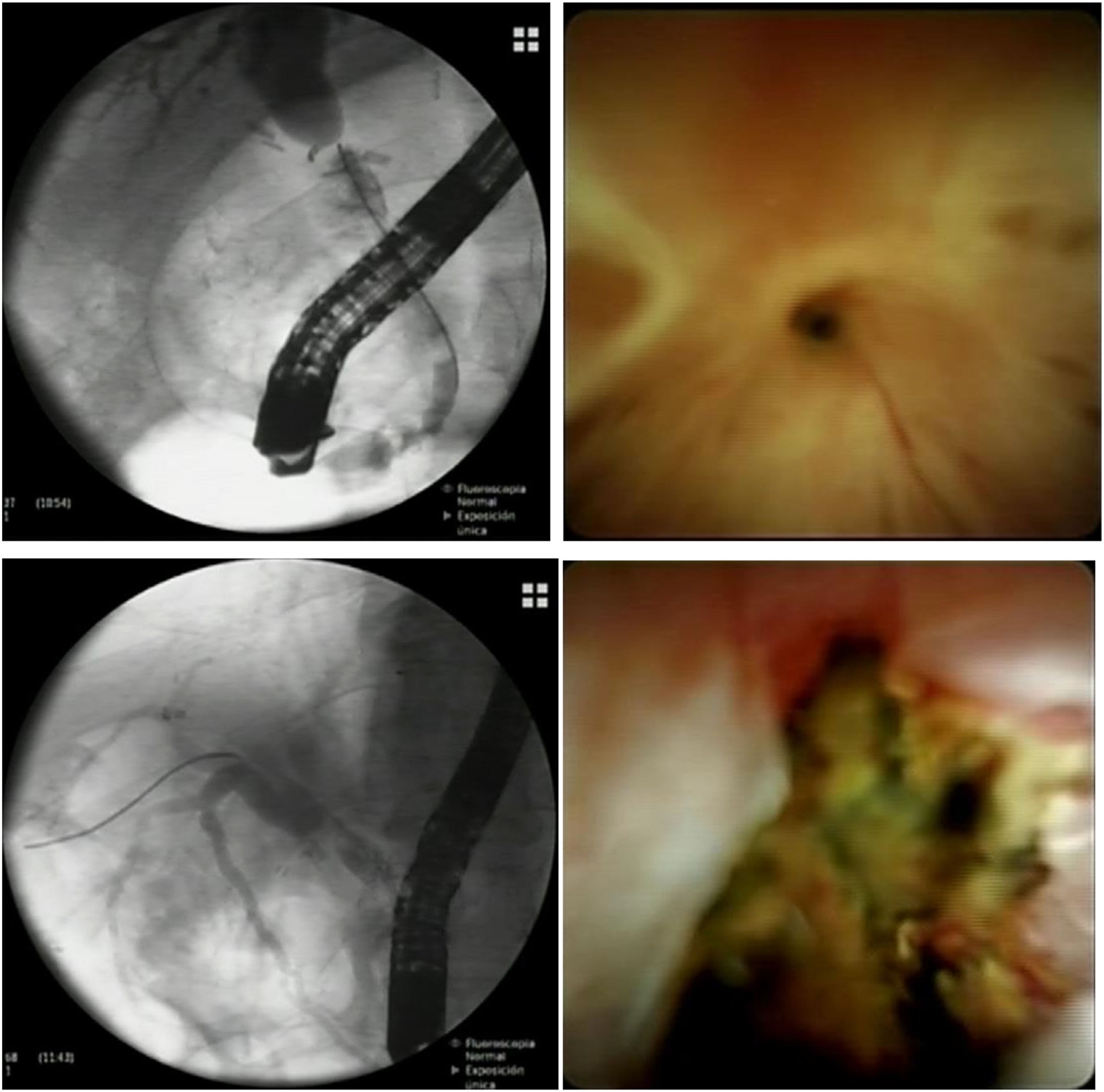 A practical approach to the endoscopic management of biliary strictures