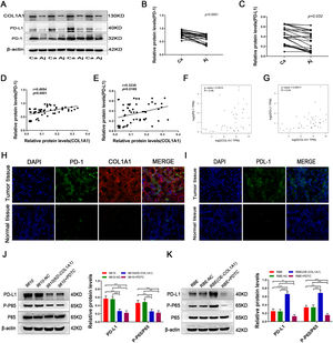 COL1A1 upregulates PD-L1 expression in CCA cells through activating the NF-κB pathway. (A) Protein expression levels of COL1A1, PD-L1 and PD-1 were detected by western blotting in 27 tumour tissues and paired adjacent normal tissues from patients with CCA. Representative blots from 4 paired samples are shown. (B) PD-1 protein expression levels in 27 tumour tissues and adjacent normal tissues. (C) PD-L1 protein expression levels as in (B). (D) Correlation between COL1A1 and PD-1 protein levels in 27 tumour tissues and adjacent normal tissues with CCA, as determined by western blotting. (E) Correlation between COL1A1 and PD-L1 protein levels as in (D). (F) Correlation between COL1A1 and PD-1 mRNAs in the TCGA database. (G) Correlation between COL1A1 and PD-L1 mRNAs in the TCGA database. (H) Visualization of PD-1 (green) and COL1A1 (red) staining in tumour tissues and adjacent normal tissues from patients with CCA by immunofluorescence microscopy. (I) Visualization of PD-1 (green) staining in tumour tissues and adjacent normal tissues from patients with CCA by immunofluorescence microscopy. (J) PD-L1, p-p65 and total p65 protein expression levels were determined by western blotting in NC, HCCC-9810 (KD-COL1A1) and HCCC-9810 cells with or without treatment with PDTC inhibitors (40 μmol/l) for 12 h. (K) PD-L1, p-p65 and total p65 protein expression levels were determined by western blotting in NC, RBE (OE-COL1A1) and RBE cells with or without treatment with PDTC inhibitors (40 μmol/l) for 24 h. *P<0.05; **P<0.01 and ***P<0.001. Experiments were repeated at least three times independently. 9810, HCCC-9810; OE, overexpression; KD, knockdown; NC, negative control.