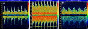 Transcranial Doppler: (A) before liver transplant; (B) 1th day after transplant; and (C) 3th day after liver transplant (28).