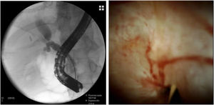 ERCP and POCS images of a tight ABS that could not be crossed with fluoroscopy despite using multiple guidewires. In this case, POCS enabled an excellent visualization of the anastomotic stricture, which showed scarring and mild erythema. POCS allowed for selective guidewire placement in the biliary tree of the graft and subsequent endoscopic treatment was performed.