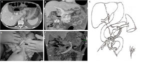 A) Preoperative CT scan: showing ascites, with normal size liver and spleen. B) Preoperative CT scan: showing SMV thromboses, SMV collaterals, intestinal wall edema and ascites, with preserved splenic vein and portal flow. C) Illustration of the SMV collateral to the splenic vein shunt. D) Surgical pictures of the shunt, showing in detail the SMV collateral anastomosis and the direction of the shunt towards the splenic vein anastomosis. E) Post-operative abdominal CT scan showing a patent shunt, absence of collaterals, intestinal wall edema and ascites. CT, computed tomography; SMV, superior mesenteric vein.