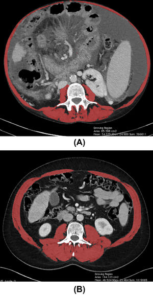 Total muscle area quantification at the level of the third lumbar vertebra using abdominal CT images from two patients with cirrhosis. (A) Female patients with low SMI (32.21 cm2/m2) and (B), and male patients with high SMI (67.17 cm2/m2), as indicated by the red shading. SMI, skeletal muscle index. (For interpretation of the references to color in this figure legend, the reader is referred to the web version of this article.)