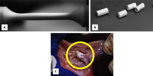 Scaffold obtained by electrospinning. A), fibers collected in dynamic collector. B), 2–3 cm sections for mechanical-biological evaluations. C) End-to-end anastomosis: common bile duct-prosthesis-common bile duct.