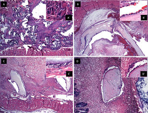 Biocompatibility in vivo. A. Panoramic view of a soft tissue section 44 days after gauze placement in subcutaneous cellular tissue, H&E technique. Chronic granulomatous inflammation of the foreign body type (textile fibers) with fibrosis is observed. A
