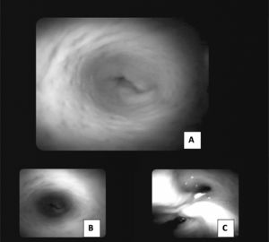 SpyGlass. Figures A and B. Internal visualization of the bile duct with follow-up at 18 months, the re-epithelialized scaffold wall is observed in the common bile duct area. Figure C. Bifurcation of the left and right hepatic ducts.