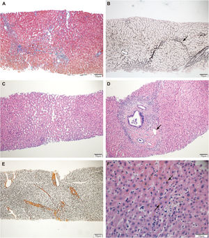 Histopathology images of patients with early PBC. Abbreviations: Early PBC, early-histologic-stage PBC (PBC in Scheuer stages Ⅰ–Ⅱ); (A) Perisinusoidal fibrosis (Masson stain, 100×). (B) Nodular regenerative hyperplasia, shown by arrow (reticulin fiber stain, 100×). (C) Dilated hepatic sinusoids (HE stain, 100×); (D) Portal vein stenosis, shown by arrow (HE stain, 100×). (E) Disorganized hepatocyte cords with fibrous septa formation in the hepatic lobules (reticular fiber stain, 100×). (F) Hepatocyte cholestasis, shown by arrow (HE stain, 200×).
