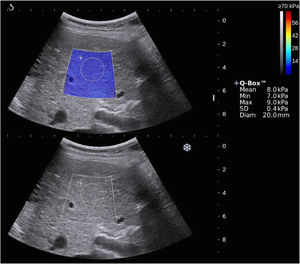 The two-dimensional shear-wave elastography (top) and gray-scale (bottom) images of the right hepatic lobe in a patient.