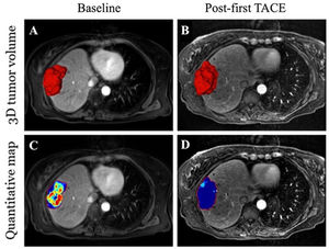 Three-dimensional segmentation and qEASL volumetric enhancement analysis on pre- and post-TACE contrast-enhanced arterial phase T1-weighted MR images.
