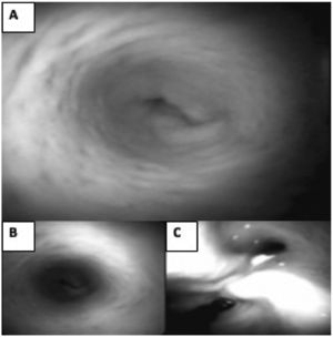 SpyGlass. Figures A and B. Internal visualization of the bile duct with follow-up at 18 months, the re-epithelialized scaffold wall is observed in the common bile duct area. Figure C. Bifurcation of the left and right hepatic ducts.