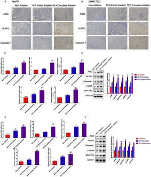 Levels of inflammasome- and pyroptosis-related molecules with radiofrequency ablation (RFA) in xenograft mouse models. HepG2 and SMMC-7721 cell-derived xenograft nude mice were treated with RFA partial ablation, RFA complete ablation, or no ablation as a control (Non-ablation). After 4 weeks, the liver tissues were collected for subsequent analysis. Immunohistochemical analysis of inflammasome proteins before and after RFA in (A) HepG2 cell-derived xenograft nude mice and (B) SMMC-7721 cell-derived xenograft nude mice. Hepatic AIM2, NLRP3, caspase-1, γ-H2AX, and DNA-PKc (C) mRNA and (D) protein expression levels in HepG2 cell-derived xenograft nude mice. Hepatic AIM2, NLRP3, caspase-1, γ-H2AX, and DNA-PKc (E) mRNA and (F) protein expression levels in SMMC-7721 cell-derived xenograft nude mice. The hepatic AIM2, NLRP3, caspase-1, γ-H2AX, and DNA-PKc mRNA and protein expression levels were significantly greater in the HepG2 and SMMC-7721 cell-derived xenograft nude mice treated with RFA partial or complete ablation compared with the no-RFA ablation control mice. There were greater effects on these protein levels in the complete ablation group versus the partial ablation group. Data are presented as the mean ± SD. *P < 0.05; **P < 0.01; ***P < 0.001.