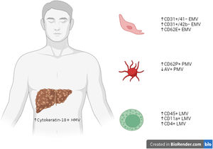 Summary figure on the main subtypes of MVs studied in cirrhotic patients, divided according to their origin from HMV, PMV, LMV or endothelial cells EMV. Created in BioRender.com. microvesicles, MVs; hepatocytes-derived MV, HMV; platelet-derived MV, PMV; leukocyte-derived MV, LMV; endothelial cell-derived MV, EMV.