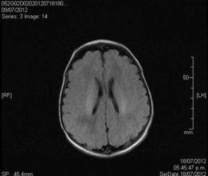 Normal MRI.