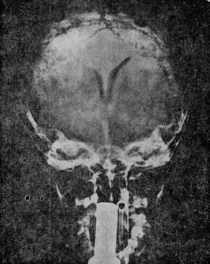 Benign intracranial hypertension. Ventriculography of a 4-and-a-half year old boy with benign intracranial hypertension, which occurred during treatment with steroids. The diminishment of the bodies of the lateral ventricles can be noted in their transverse diameter in the anteroposterior projection, with the forehead facing up.