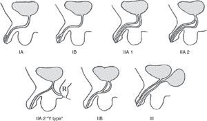 Effmann's classification for urethral duplication.4