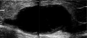 Reconstructed ultrasound image which shows an internal saphenous vein venous aneurism of 9×5cm, which compression did not remove.