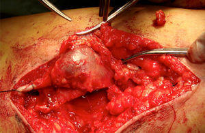 Surgical excision of the internal saphenous vein venous aneurisms.