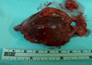 Thrombosed internal saphenous vein venous aneurysm.