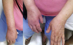 Female with upper member CRPS affected, posterior entitled to 20 days of completing treatment with infusion pump to the infraclavicular brachial plexus (Ropivacaine 2%22).