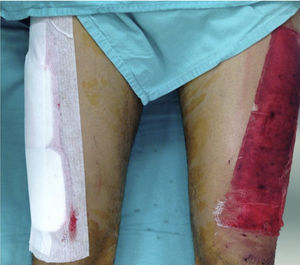 Patient with bilateral donor site: one side was covered with Mepilex (right) and the contralateral side (left) with non-adherent gauze.