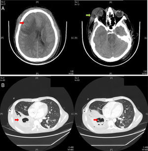(A) Brain CT, revealing a right frontoparietal mass with brain edema (red arrow), midline deviation and ventricular collapse. The right periorbital edema is also observed together with ipsilateral periorbital cellulite (green arrow). (B) Chest contrast CT, where a right pleural effusion (red arrow, left) and a mild bilateral pulmonary parenchymal infiltrate and cavitation (red arrow, right) are observed. (For interpretation of the references to color in this figure legend, the reader is referred to the web version of this article.)