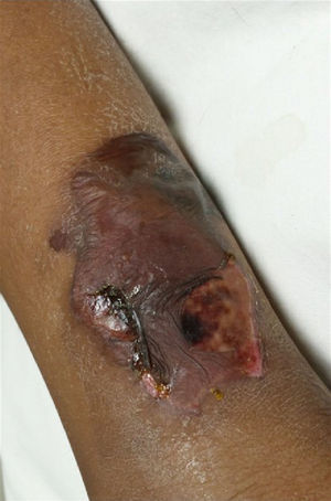 Skin and soft tissue necrotic lesions suggesting septic thromboembolism.