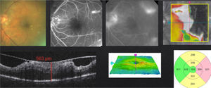 DME with a thickening of the vitroretinal interface and vitromacular traction syndrome.