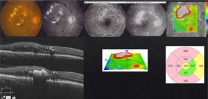 Focal DME with foveal involvement.