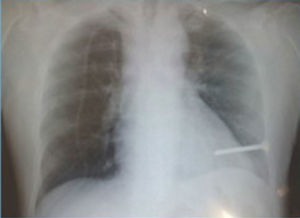 Chest X-ray showing nail inside cardiac silhouette.