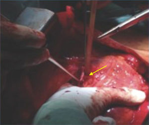 Ventricular repair with pericardial patch (yellow arrow).