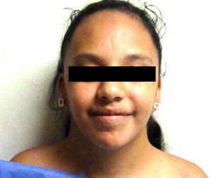 Craniofacial dysmorphias in a patient with TS. Down-slanting eyelid openings, ptosis, low-set pinnae and a wide and short neck can be observed.