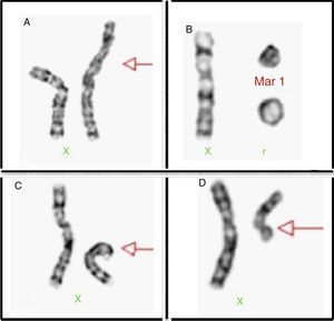 Examples of chromosome X structural alterations. (A) Isochromosome of the long arm of X. (B) Chromosomal mark and a ring. (C) Deletion of the short arm of the X chromosome. (D) Deletion of the long arm of X chromosome.