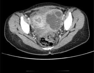Abdominal CT scan, which shows a collection in the pelvic gap.
