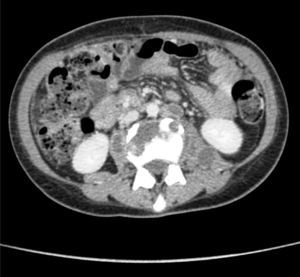 Abdominal CT scan, which shows a left psoas abscess.