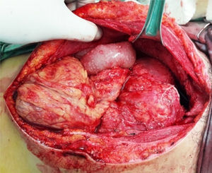 Trans-operatory image, which shows granulomatous lesions in the small intestine, colon and omentum.