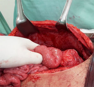 Trans-operatory image, which shows granulomatous lesions in the small intestine and peritoneum.