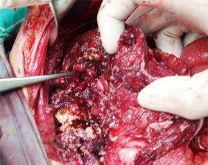 Trans-operatory image, which shows perforation of the cecum and ascending colon.