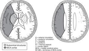 Outline of the division of the territory of the middle cerebral artery into 10 regions for the ASPECTS scale (less of 7, means more than 1/3 of the artery territory involved).