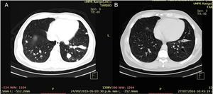Basal CT scan shows multiple lung metastases (A), and complete radiological response after twelve cycles of immunotherapy. Patient 1.