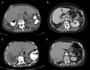 CT shows a metastatic soft tissue lesion (abdominal wall) (A) and a complete response after 8 cycles of immunotherapy (B). (C) A 12cm liver metastasis and a partial response (D) after 8 cycles of immunotherapy. Patient 2.