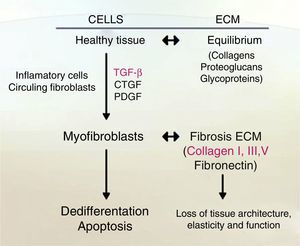 Common pathological consequences of chronic liver disease. The liver tissue suffers morphological changes while liver damage happens; this figure shows the comparison between different stages of liver tissue and changes over ECM.