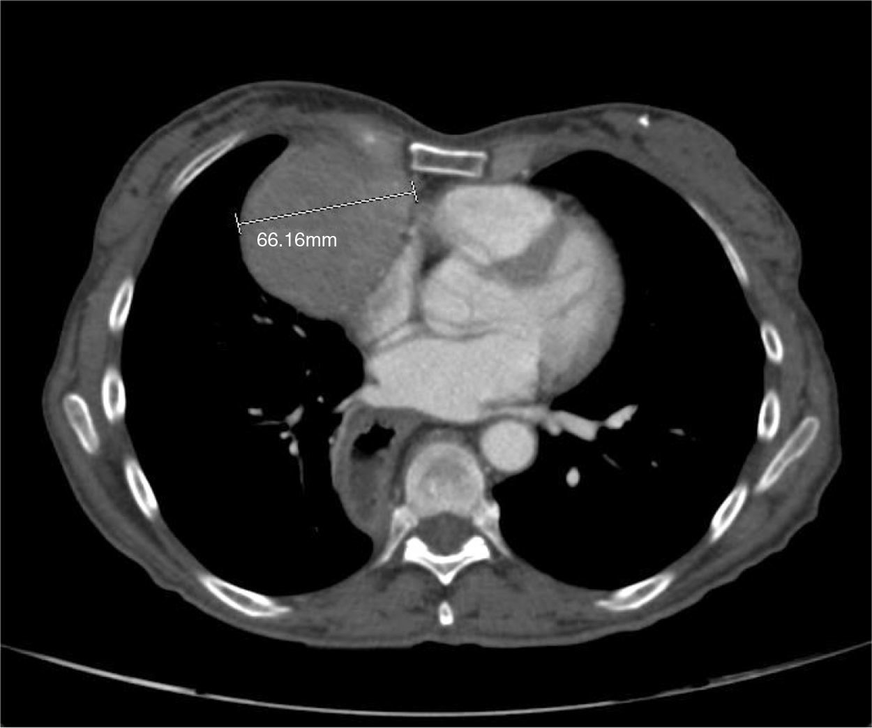 Good syndrome associated with pure red cell aplasia in a patient with a  history of thymoma: A case report and literature review | Medicina  Universitaria