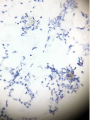 Bone marrow biopsy showing positivity of CD 71 staining on a healthy patient (positive control).