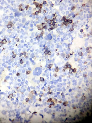 Bone marrow biopsy of the case presented showing absence of CD 71 staining, corresponding with pure red cell aplasia.