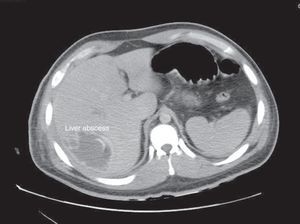 Axial computed tomography of a patient with a pyogenic liver abscess.