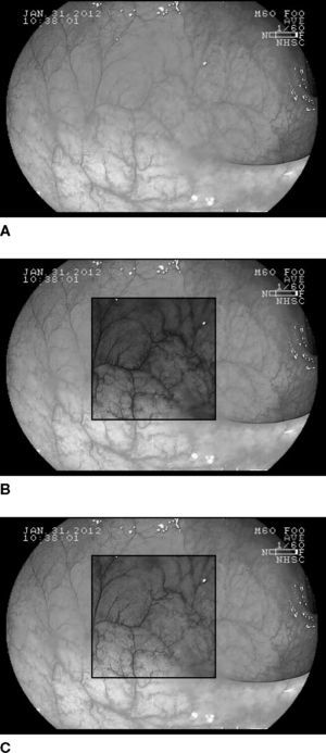 The experiment demonstrates the proposed adaptive imaging method applied to observe the vascular polyp of the image pair five images in our dataset. A: the traditional gastrointestinal endoscopy image of a normal patient. B: the endoscopy image with enhanced area by FICE Channel 4. C: the endoscopy image with enhanced area by the proposed contrast adaptive imaging method.