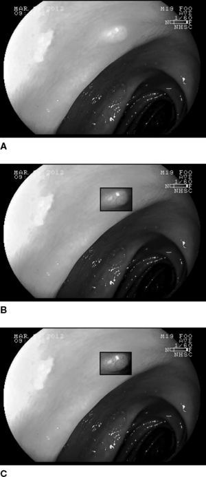 The experiment demonstrates the proposed adaptive imaging method applied to observe the hyperplastic polyp of the image pair 31 image in our dataset. A: traditional gastrintestinal endoscopy image of a normal patient. B: endoscopy image with enhanced area by FICE Channel 4. C: the endoscopy image with enhanced area by the proposed contrast adaptive imaging method.