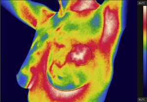 Thermal image from a patient with an infiltrating ductal carcinoma.