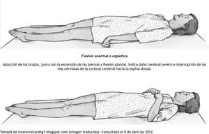 Postura de descerebración.