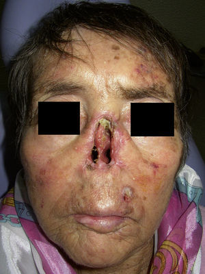 Paciente con rinectomía, mostrando el gran defecto facial producido por la cirugía resectiva.