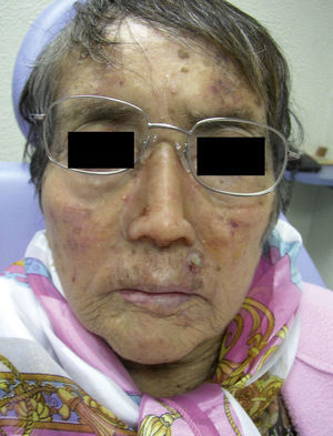 Misma paciente de la Figura 2 con rinectomía que muestra la apariencia facial mediante el uso de una prótesis de nariz adecuada.